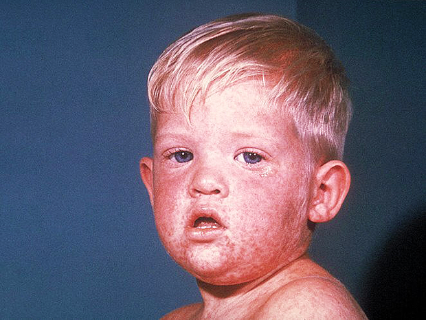 measles3.jpg 