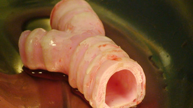 First lab-grown windpipe saves cancer patient 