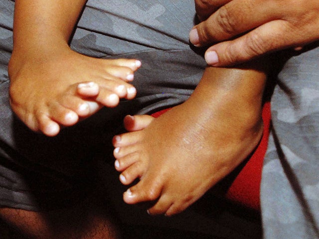 Man with 12 fingers, 12 toes vs. boy with 34 digits