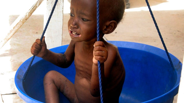 A malnourished Somali child is weighed during an aid distribution in Mogadishu, Somalia, Aug. 10, 2011. The United Nations estimates that tens of thousands of people have died from malnutrition in Somalia in recent months, and more than 11 million people  
