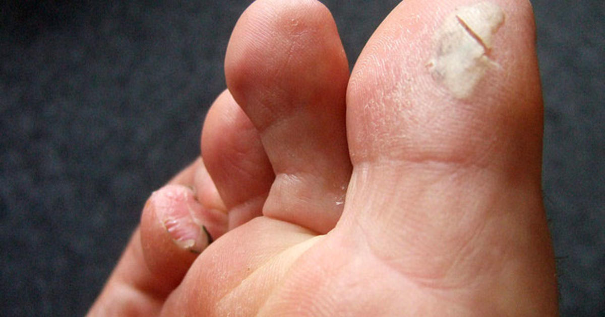 Does an Ingrown Toenail Require Medical Assistance?: Eric Blanson