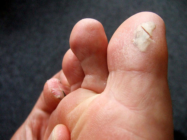 blisters, foot, feet 