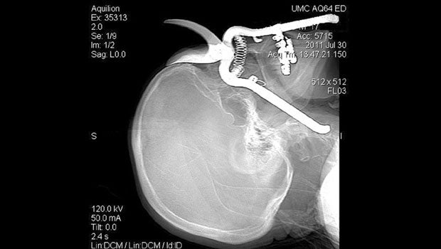 pruning, eye impalement, full width 