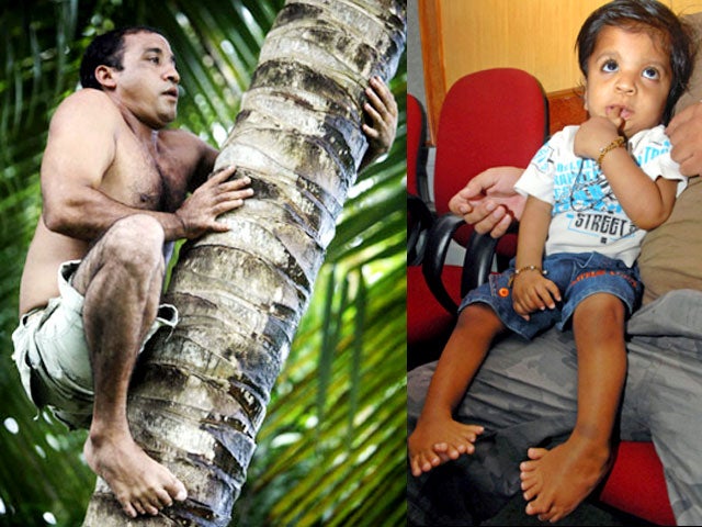 Man with 12 fingers, 12 toes vs. boy with 34 digits
