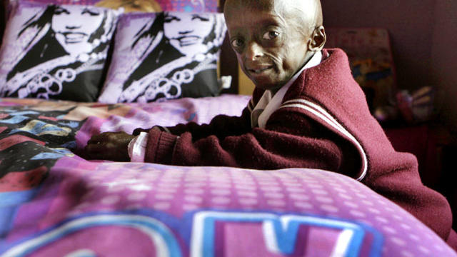 progeria-AP11082419493.jpg 