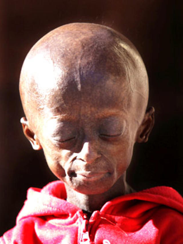 Progeria: First black child with rare aging disease