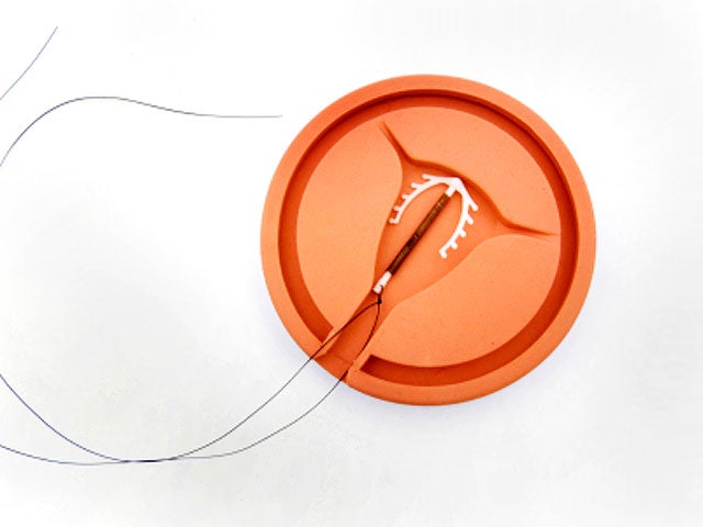 Medical group says teens should use IUDs, implants as first ...