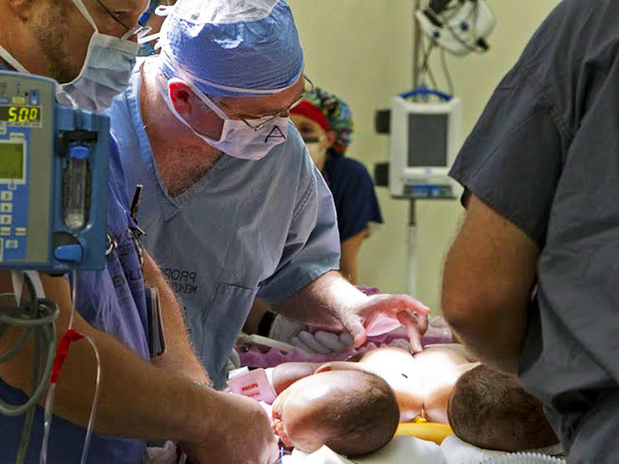 Medical Miracle? Conjoined Twins Separated In Memphis