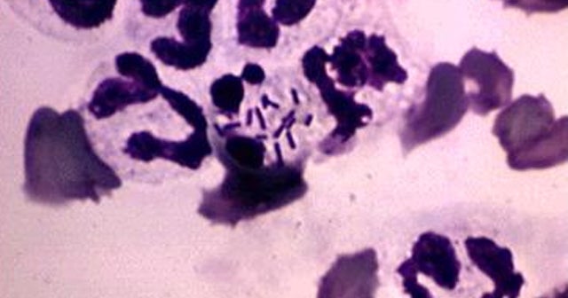 Listeriacantaloupelinked deaths rise to 16 CBS News