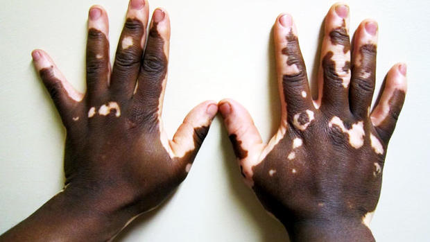 Vitiligo: Illustrated guide to pigmentation disorder 