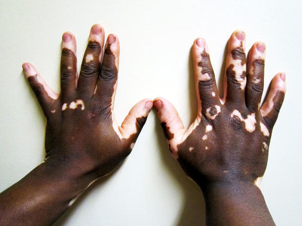 vitiligo 