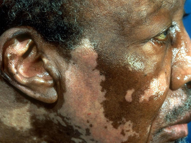 vitiligoface.jpg 
