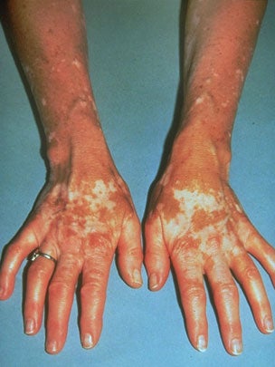 vitiligo 