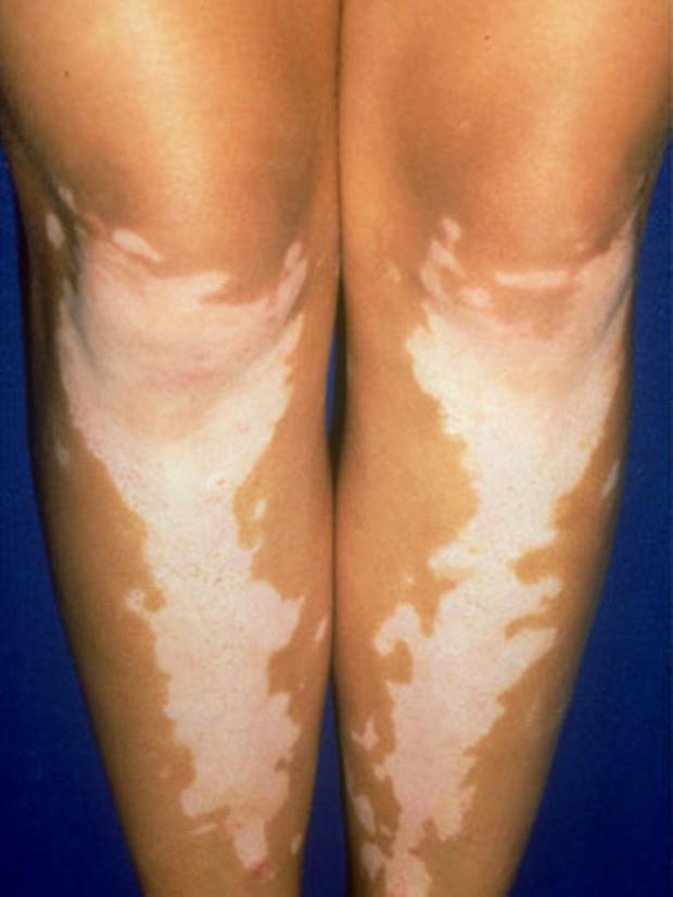 vitiligolegs.jpg 