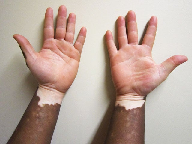 Vitiligo Illustrated guide to pigmentation disorder