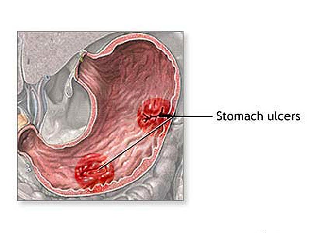 stomach ache, cramps, pain, diarrhea, crohn's disease, stock, 4x3 