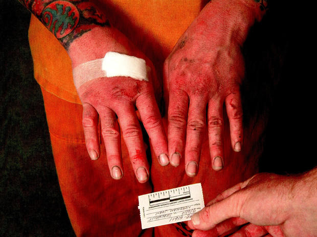 John Needham's bruised and bloody hands 