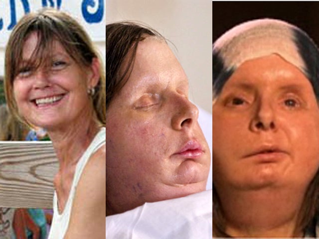 Charla Nash Woman Had Face And Hands Ripped Off By Pet Chimp Who 'ate