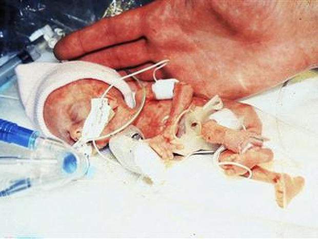 tiniest baby, preemie, premature, madeline mann 