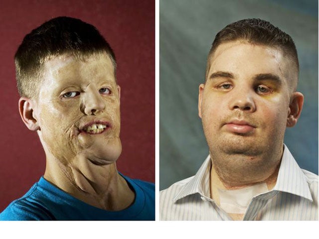 face transplant, mitch hunter, brigham and women's hospital 