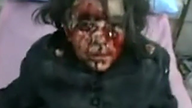 Young girl wounded in shelling of Homs 