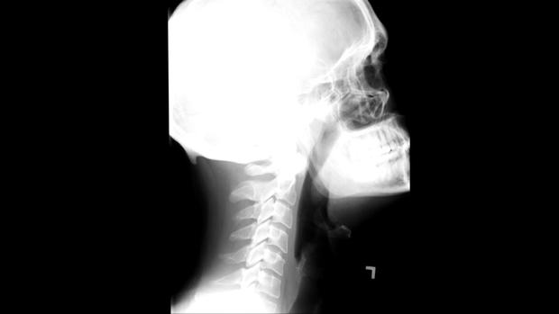 20120 Nick Koenig X-ray sans bullet 