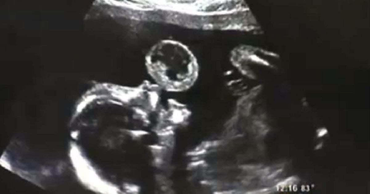 Miami doctors remove tennis ballsized tumor from fetus' mouth in