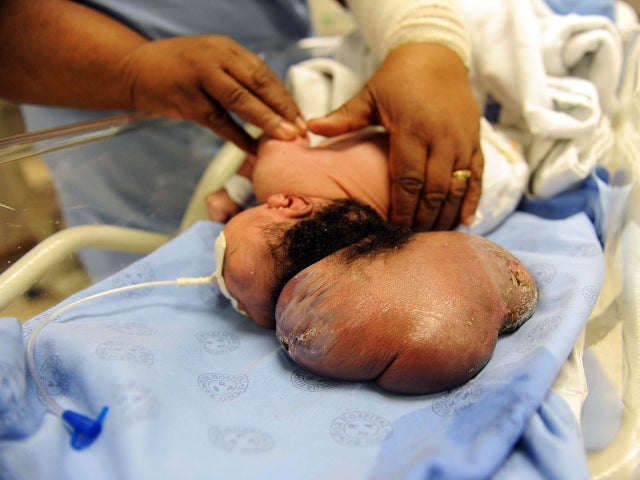 baby mokoena, anencephaly 