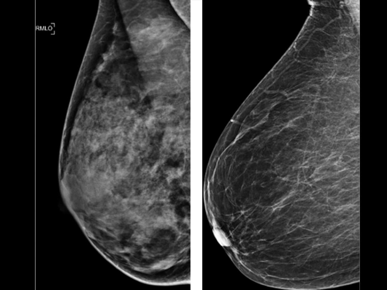 Medical practitioners will have to notify patients about breast density ...