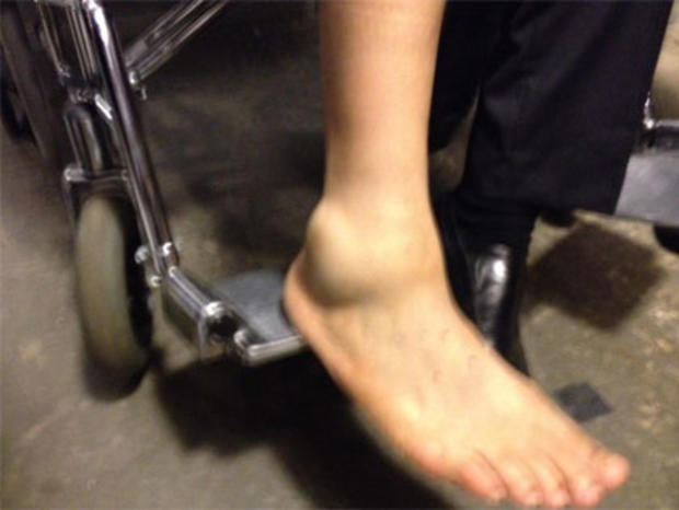 Cory Booker's Sprained Ankle 
