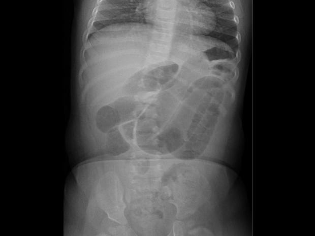 x-ray-swallowed-ball.jpg 