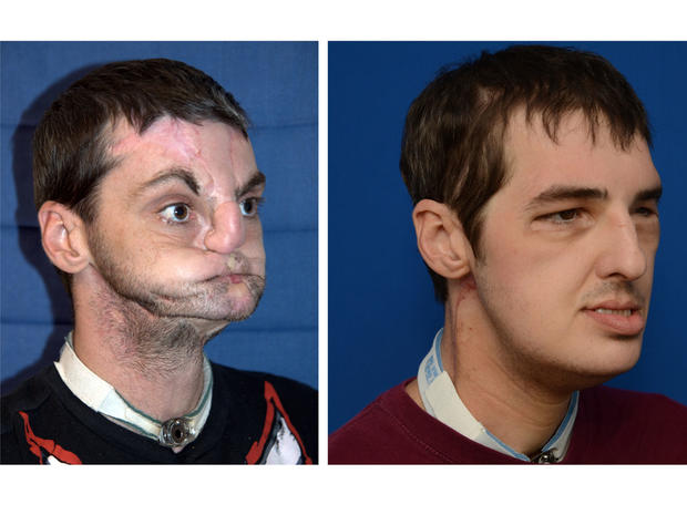 face-transplant.jpg 