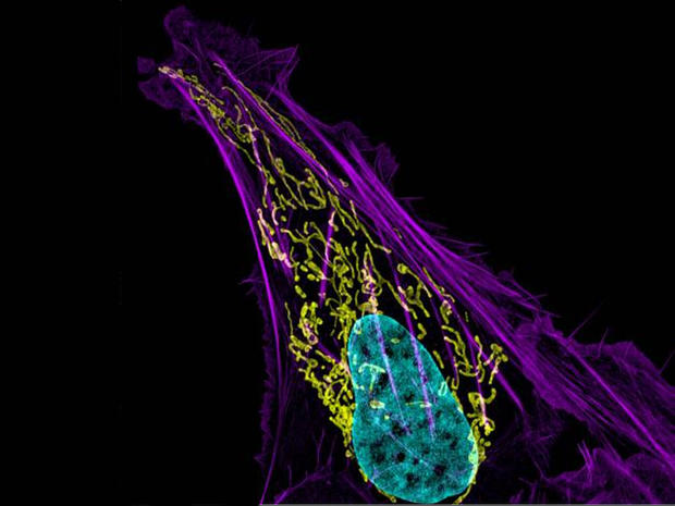 Human bone cancer (osteosarcoma) showing actin filaments (purple), mitochondria (yellow), and DNA (blue) (63x) 