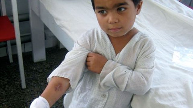 A child shows his shrapnel wound while recovering at Emergency hospital, a donation-based trauma center in Kabul. 
