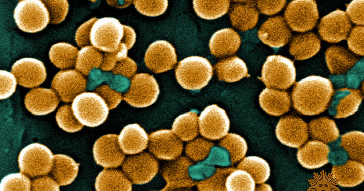 Superbugs: A ticking time bomb - CBS News