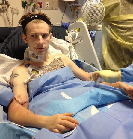 Quadruple amputee vet gets double arm transplant