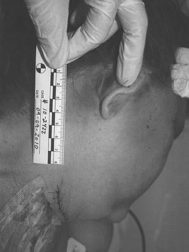A technician holds up a ruler to show the size of a hematoma located behind Marti's ear. 