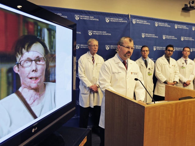 face transplant, lye victim, brigham and women's hospital, carmen blandin tarleton 