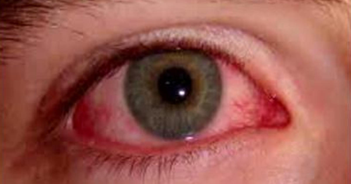 Tips for treating pink eye