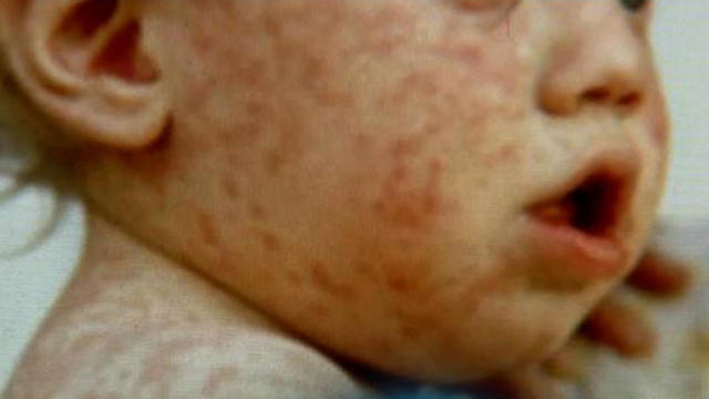 measles-baby.jpg 