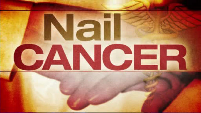nail-cancer.jpg 
