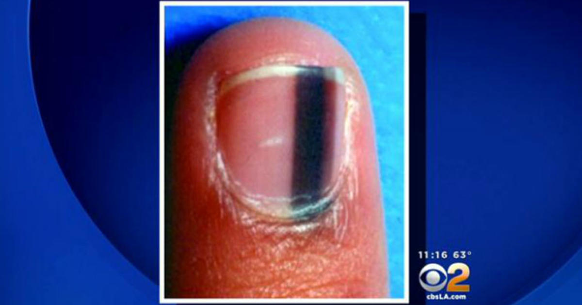 Doctor Details Tips To Spot Deadly Form Of Nail Cancer - CBS Pittsburgh