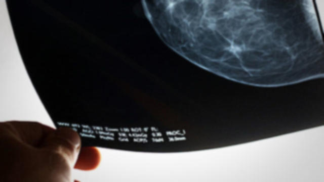 mammogram-examined-620x350.jpg 