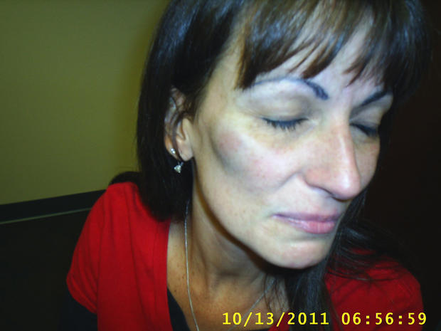 Michele Williams' bruised cheek 