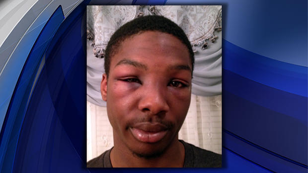 Kyle Howell is suing Nassau County PD for what he claims was an unprovoked beating 