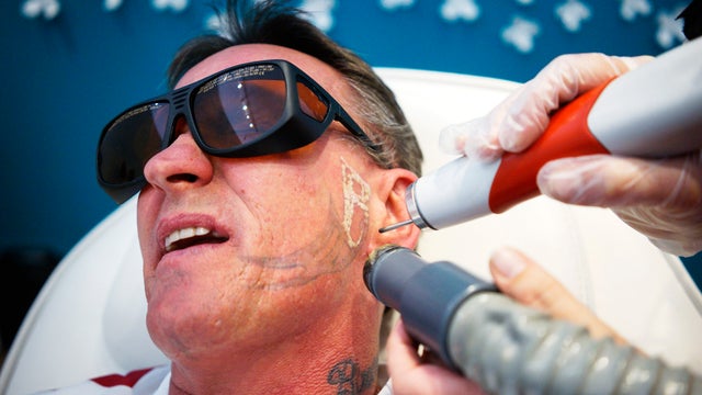 Tattoo removal for ex-convicts 
