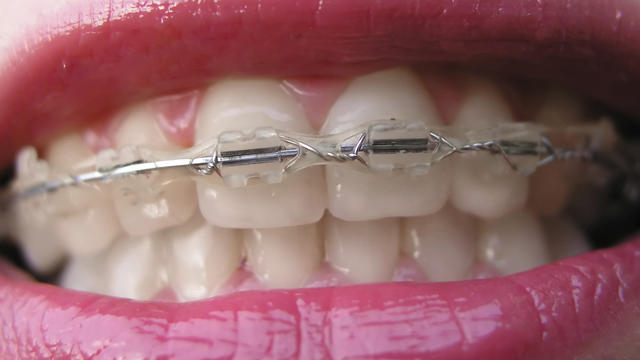 braces.jpg 