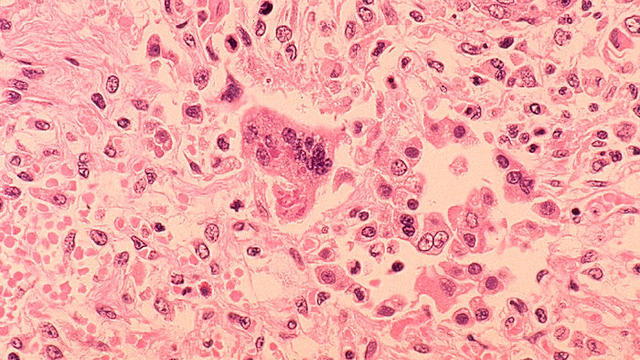 measles-virus.jpg 