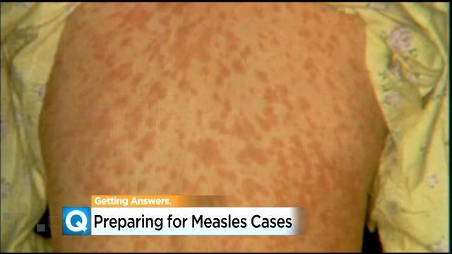 measles2.jpg 
