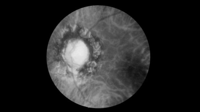 ocular-syphillis1.jpg 